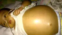 Bayi Abel Butuh Bantuan Dana untuk Transplantasi Hati