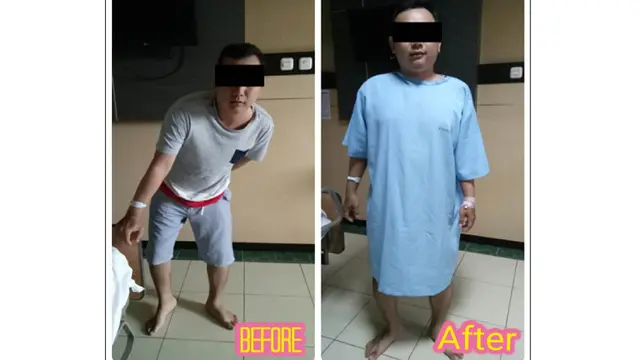Saraf kejepit atau PELD