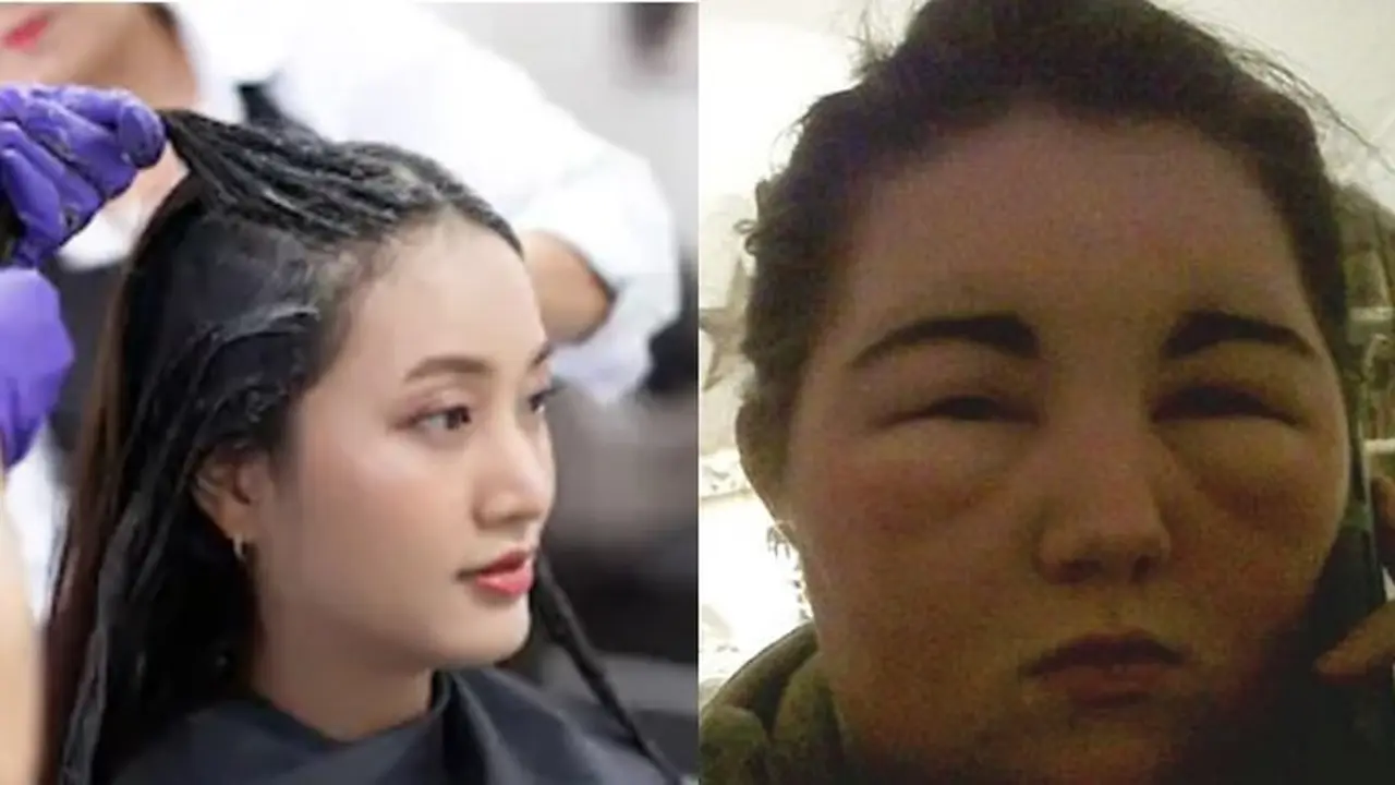 Gara-Gara Warnai Rambut, Wanita Ini Alami Alergi Matahari