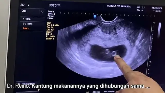 Mulai Rasakan Mual, Ini 6 Momen Zaskia Sungkar Cek USG Pertama Kali