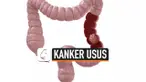 THUMBNAIL KANKER USUS