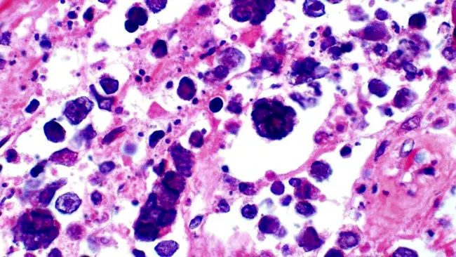 Setelah sebelumnya diumumkan sebagai penelitian ilmiah, penggunaan virus herpes untuk membasmi kanker kulit telah menjadi kenyataan.