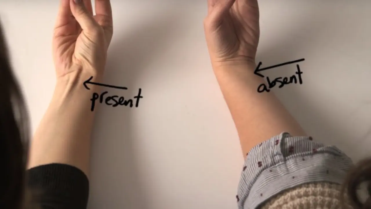 otot palmaris longus