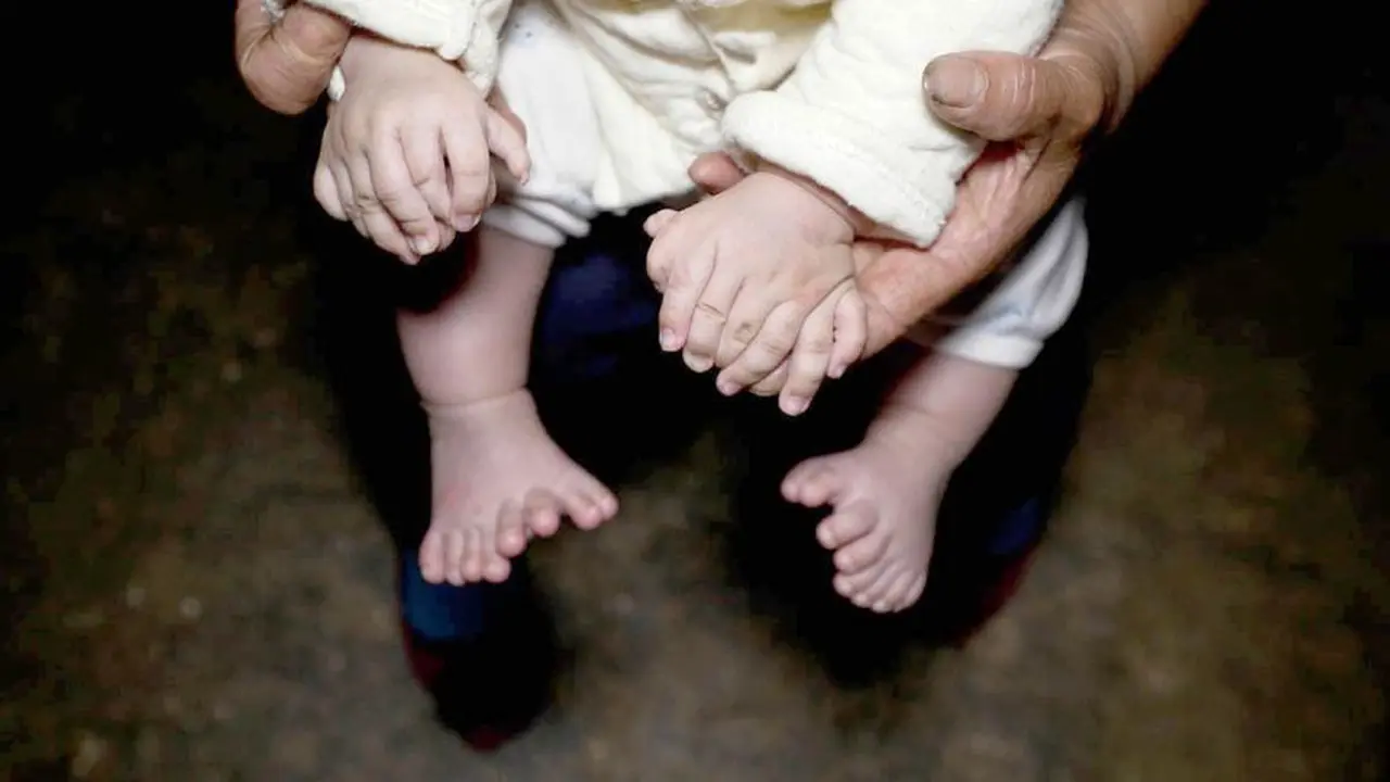 Hong Hong, bayi yang punya Jari Tangan dan kaki berlebih