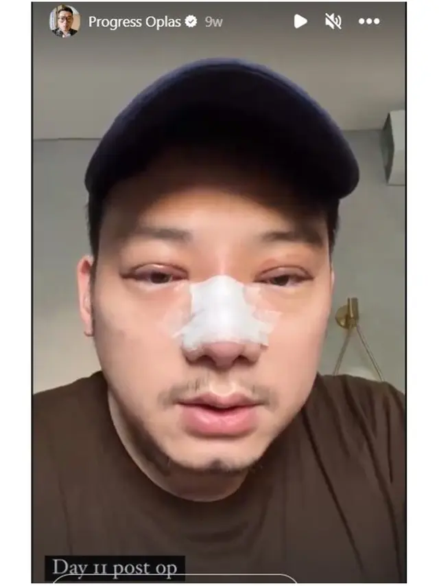 7 Potret Chef William Gozali Jalani Operasi Plastik, Perubahannya Bikin Pangling