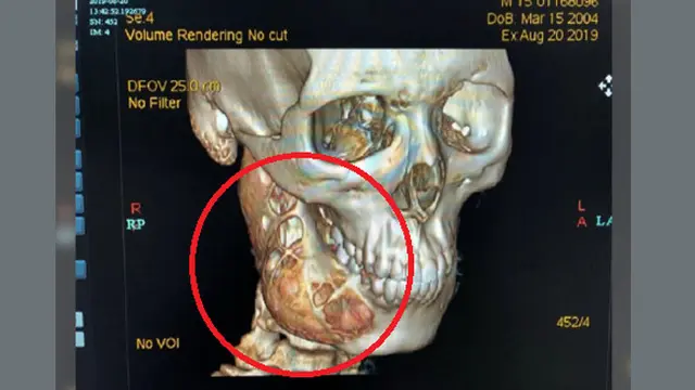 Abaikan Sakit Gigi Lebih dari Setahun, Remaja Ini Malah Kena Tumor Rahang
