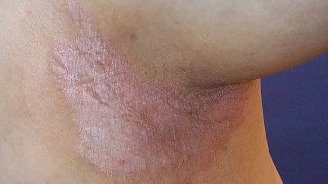 Inverse psoriasis