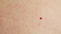 Bintik merah ini biasa disebut angioma dan merupakan tumor jinak pembuluh darah. Apa yang harus kita lakukan?
