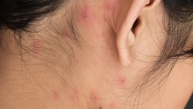 Wajah Bopeng Bekas Cacar Air? Hilangkan dengan Cara Ini! (frank60/Shutterstock)