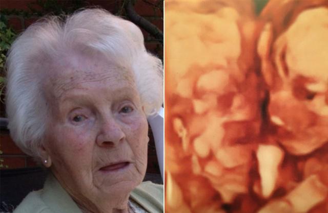 Kalau dilihat dengan sangat jeli, memang sekilas terlihat wajah neneknya Sacha di hasil USG | Photo: Copyright metro.co.uk 