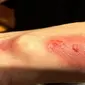 Bahan nikel yang dipakai pada Fitbit Force menyebabkan iritasi. Pengguna mengeluhkan gelang itu mengakibatkan timbul ruam di tangannya.