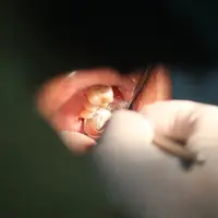 ilustrasi gigi berlubang.Photo by Mufid Majnun on Unsplash