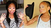 Meski Terkena Vitiligo, Gadis Cilik ini Laris Jadi Model