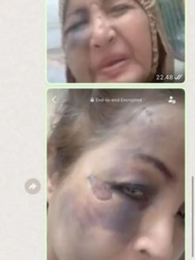 Penyanyi Senior Machica Mochtar Jadi Korban Tabrak Lari, Muka Penuh Lebam. (instagram.com/machicamochtar70)