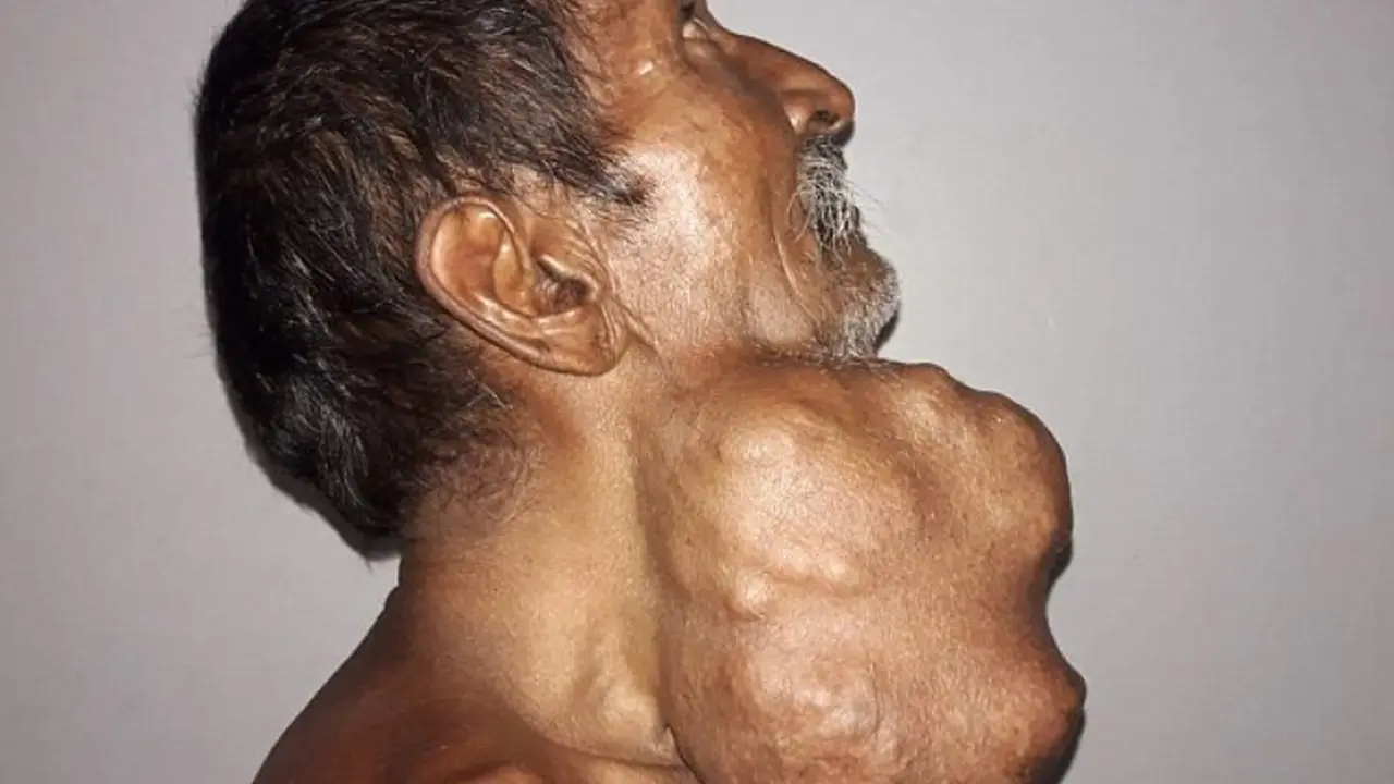 Dibiarkan 20 Tahun, Tumor 1,4 Kg di Kelenjar Ludah Pria Ini Akhirnya Diangkat