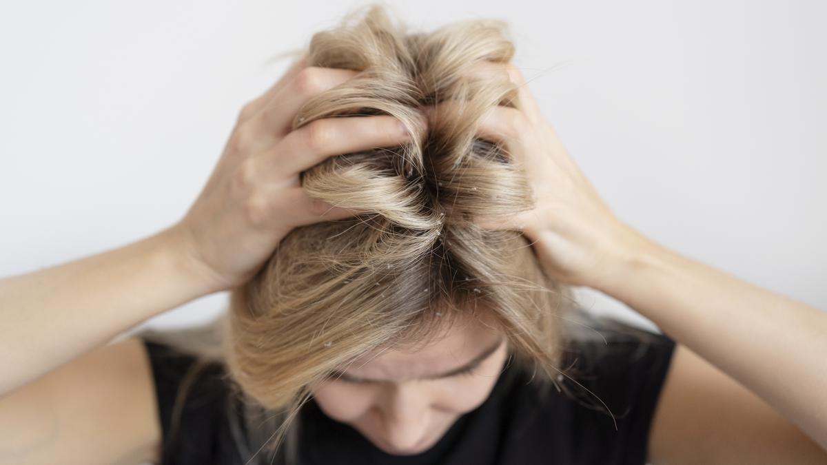 5 Tips Mengatasi Ketombe dengan Cara Alami