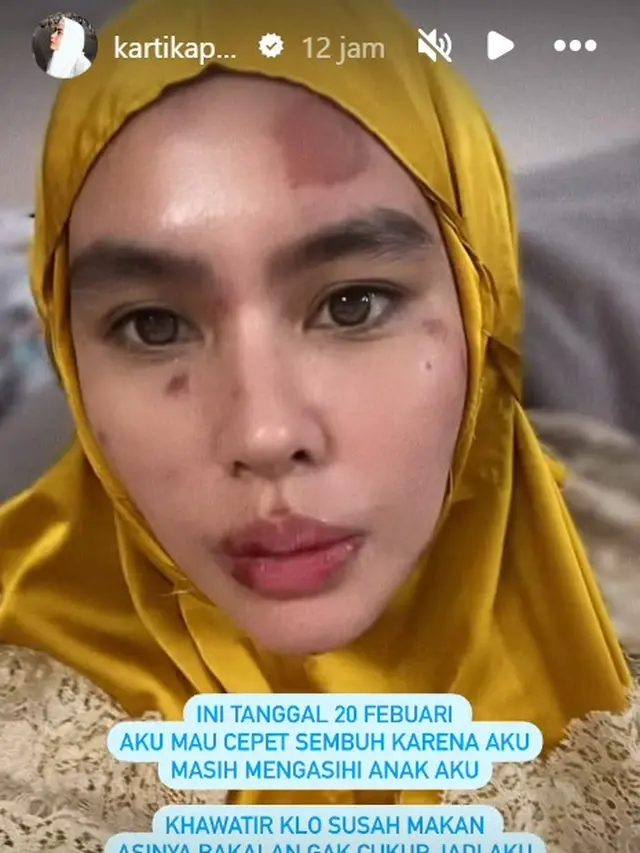 Kartika Putri kena ruam di wajahnya (Instagram/kartikaputriworld)
