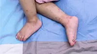 Prurigo, masalah kulit pada anak. (Foto: Babyologist)