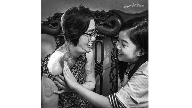 Potret Perjuangan Wanita yang Disiram Air Keras Oleh Mantan Suami Ini Bikin Miris