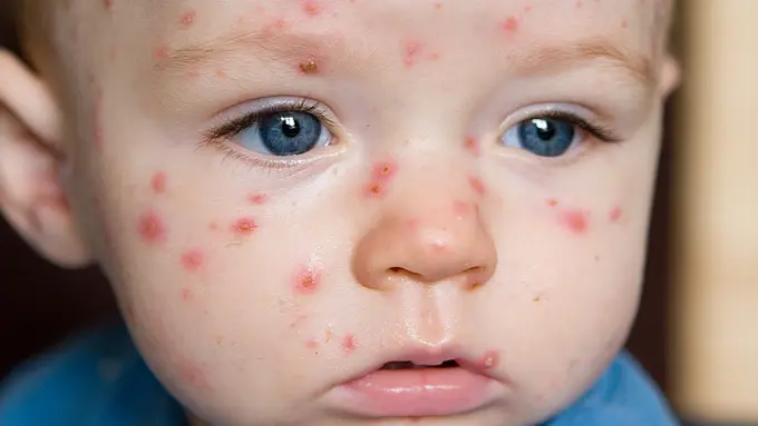 Selain ke Dokter, Pakai 5 Bahan Alami Ini untuk Obati Cacar Air