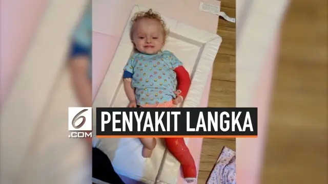 Seorang anak berusia 2 tahun mengidap penyakit langka Osteogenesis Imperfecta (OI) atau yang dikenal penyakit tulang rapuh. Kondisi itu dialaminya sejak berusia 3 bulan.