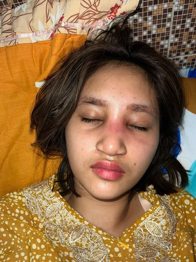 Sempat Oplas, Ini 6 Potret Permesta Dhyaz Anak Farida Nurhan Alami Infeksi Implan