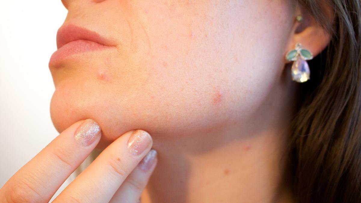 Tanda Mengidap Dermatillomania, Punya Kebiasaan Mencabut Kulit Kering
