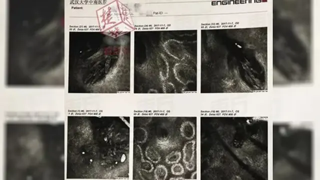 Ratusan Tungau Bersarang di Bulu Mata Wanita Ini, Akibatnya...