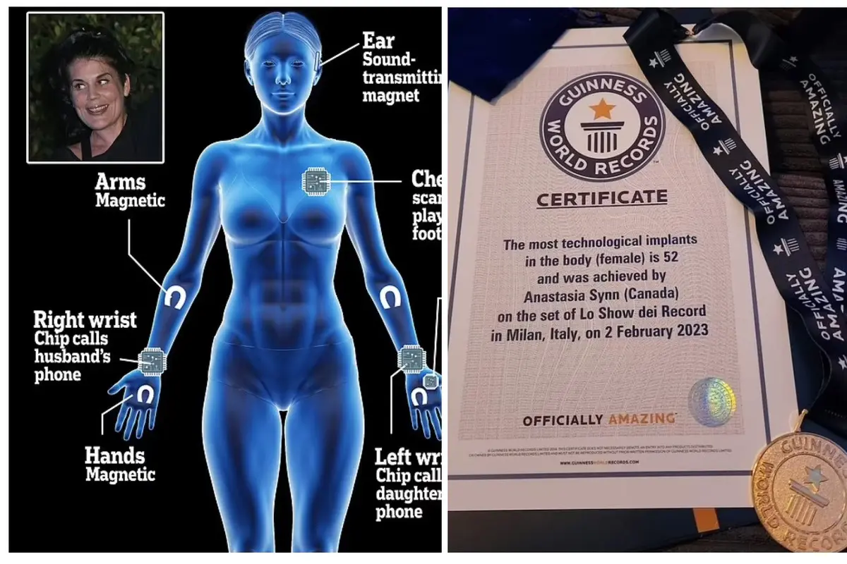 Wanita dengan 52 Implant Pecahkan Rekor Dunia