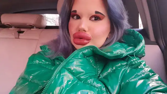Ingin Tampil Bak Boneka, Wanita Akan Injeksi Bibir Ke 27 Kali Akhir Tahun Ini