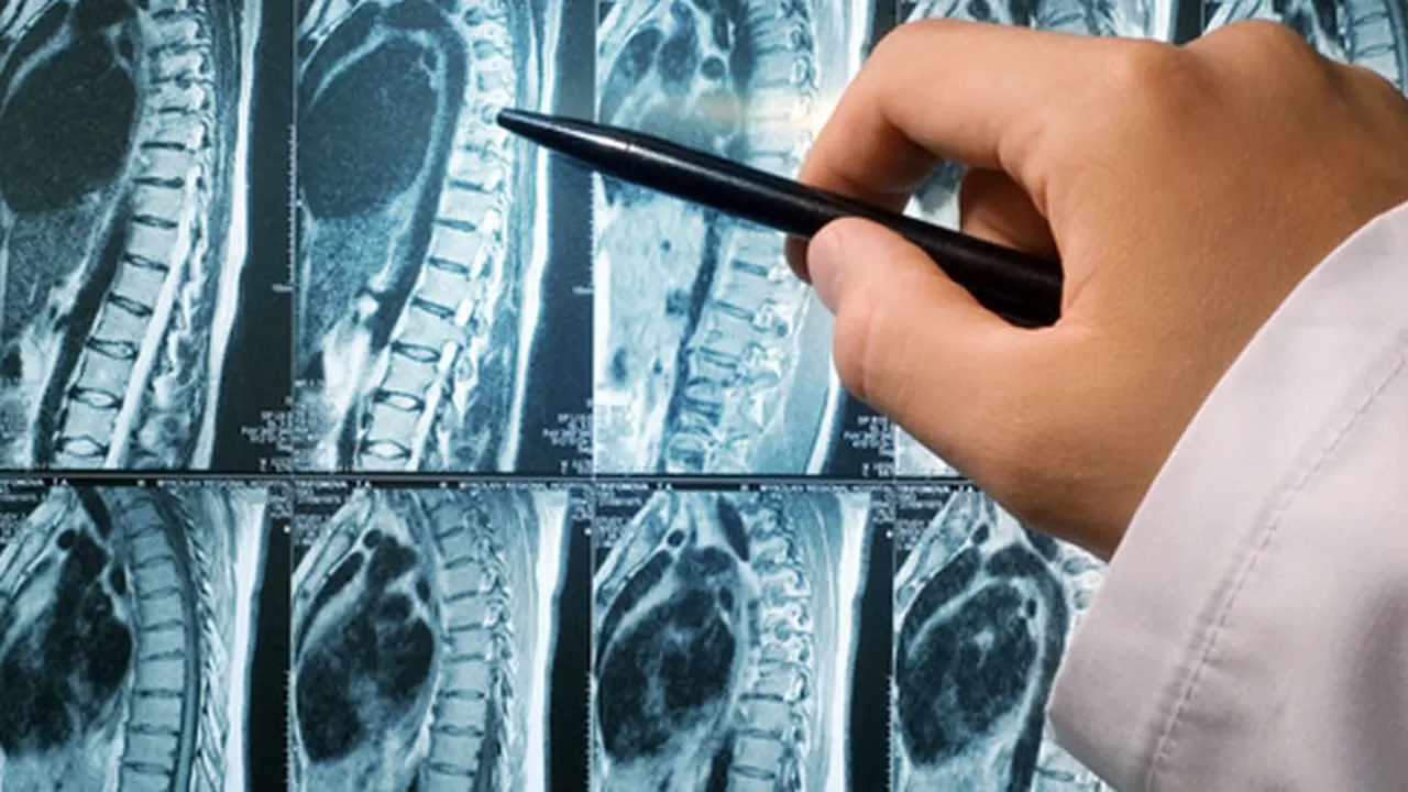 skoliosis-131219b.jpg