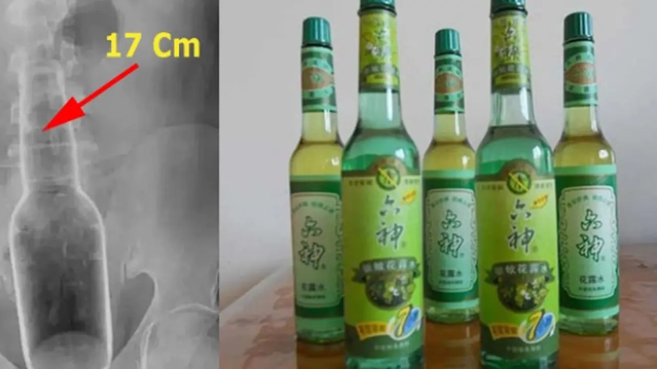 botol 17cm terjebak di anus