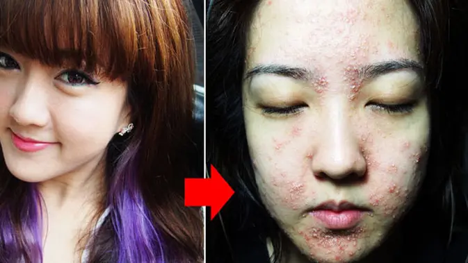 Wajah Gadis Cantik Ini Rusak Setelah Facial Beauty Fimela Com