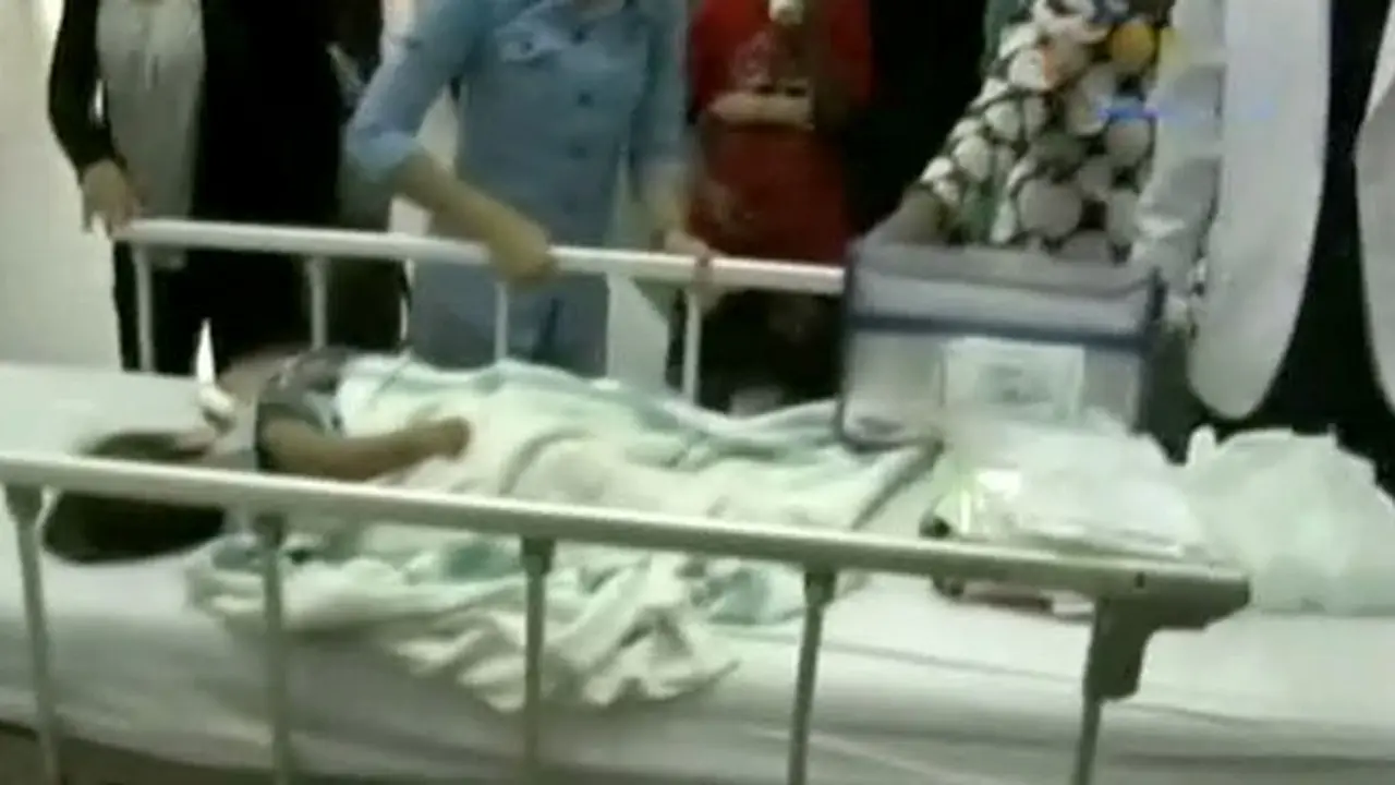 Bayi Kembar Siam Akan di Operasi