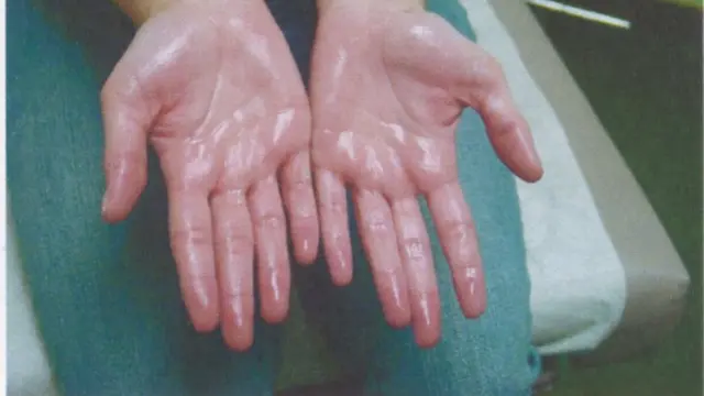 Hiperhidrosis