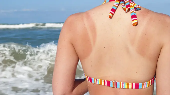 Cara Mudah Mengatasi Kulit Belang