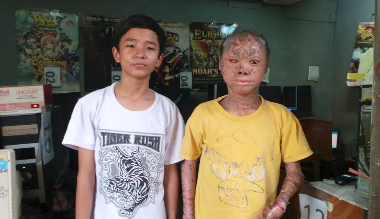Ari Wibowo menjadi "populer" lantaran dirinya memiliki kulit bersisik seperti ular. (Liputan6.com/Benedikta Desideria)