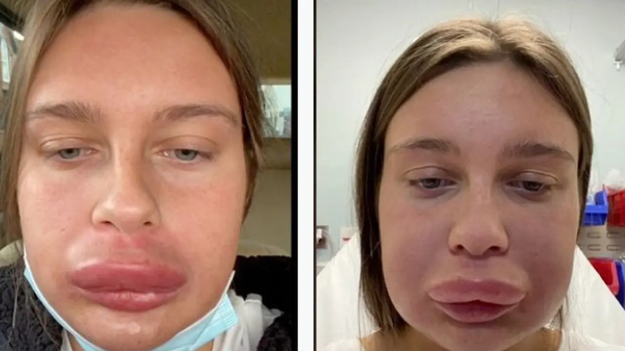 Filler Bibir Berujung Alergi Parah, Bibir Wanita Ini Bengkak Seperti Paruh Bebek