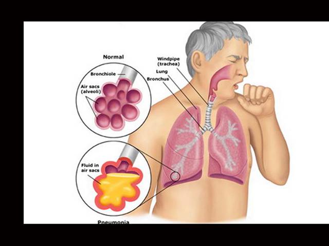 7 Tanda Penyakit Tuberkulosis Yang Perlu Diwaspadai Health Liputan6 Com