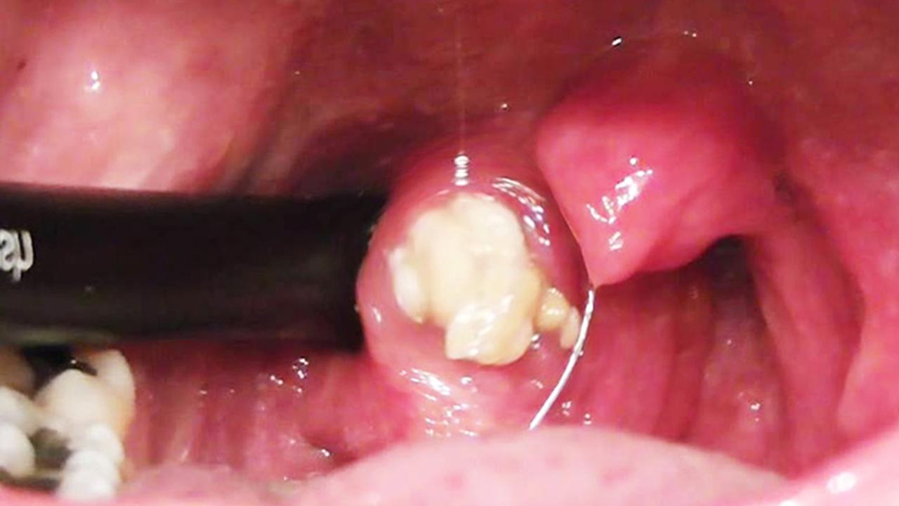 20151217-Ilustrasi Amandel