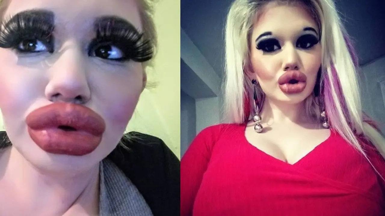 gadis ini miliki bibir terbesar di dunia