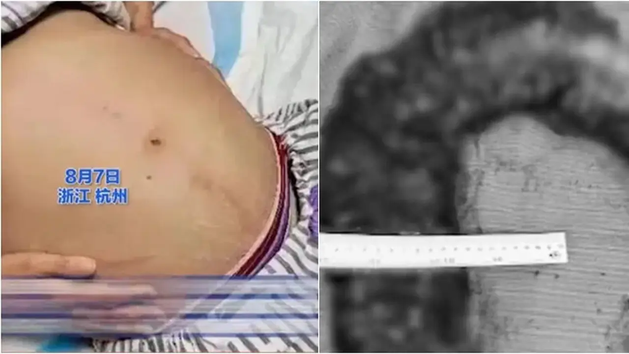 Wanita Ini Alami Sembelit Selama 10 Hari, Keluarkan 20 kg Kotoran 'Berbentuk Piton'