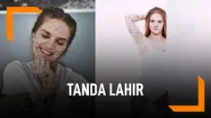 Wanita Ini Punya Tanda Lahir di Sekujur Tubuh