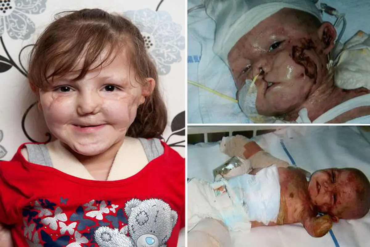Meningitis Rusak Tubuh Si Kecil Nan Cantik Ini