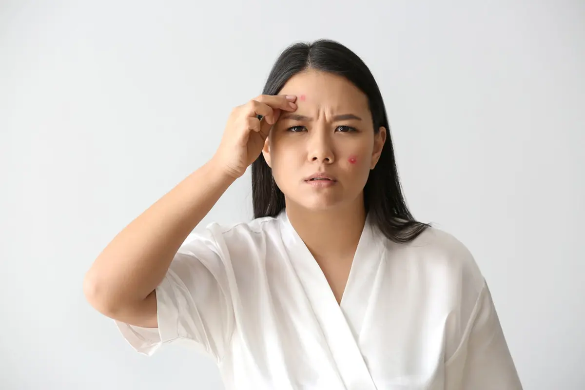 Jerawat pada Ibu Hamil, Awas Penanganan Kurang Tepat! Intip Penyebab dan Cara Aman Mengatasinya