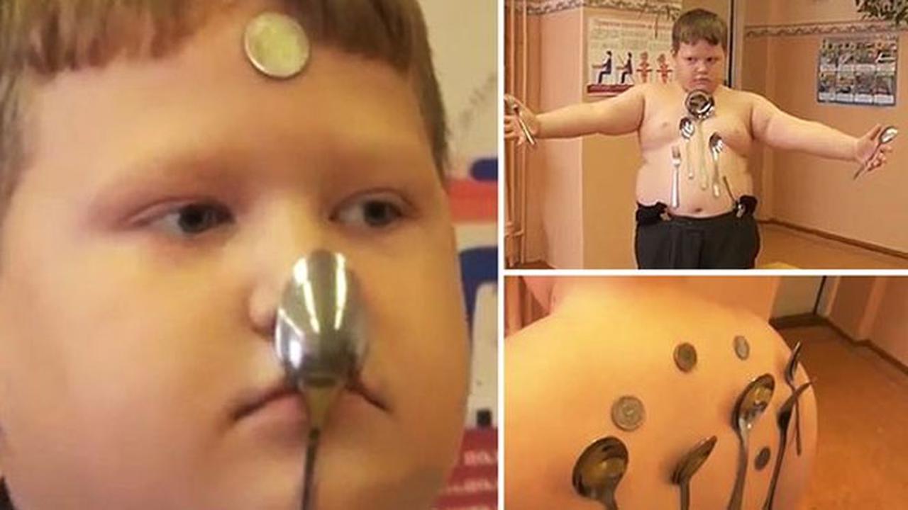 Bocah 12 Tahun jadi Manusia Magnet Setelah Tersengat Listrik