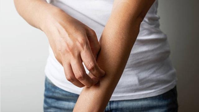 ilustrasi kulit gatal