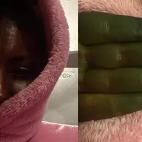 Setiap wanita pasti ingin tampil cantik, tapi bagaimana kalau gagal total dan membuatnya harus terlihat seperti Hulk? (Sumber Foto: Mirror)