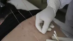 Akupuntur Berujung Petaka, 10 Jarum Tertinggal di Kaki Wanita