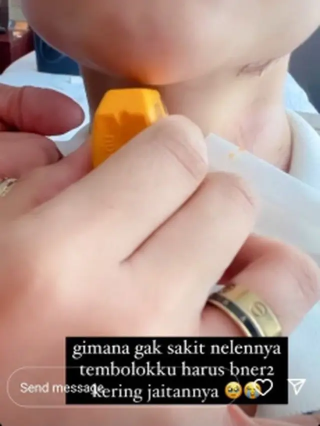 6 Potret Hasil Operasi Potong Jakun Lucinta Luna, Belum Bisa Menelan
